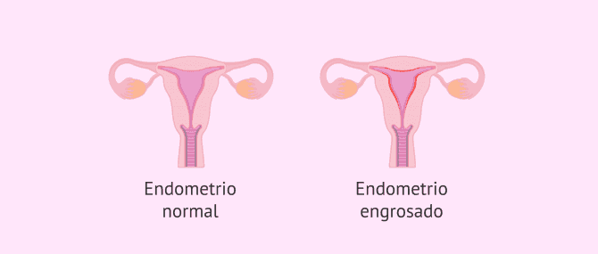 Imagen: Endometrio normal y endometrio con hiperplasia