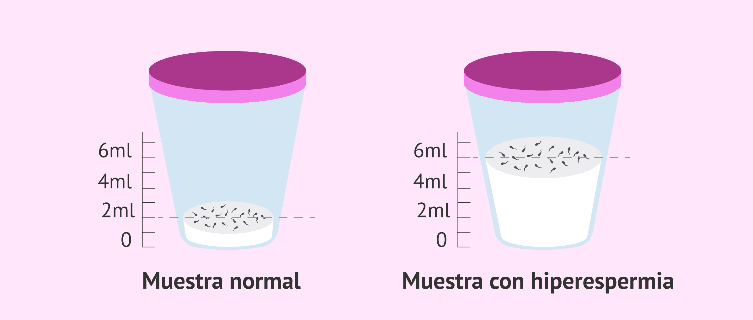 ¿Qué es la hiperespermia?