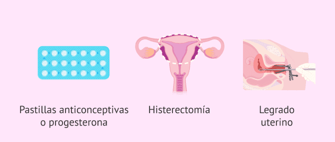Imagen: Posibilidad de tratamientos para la hiperplasia endometrial