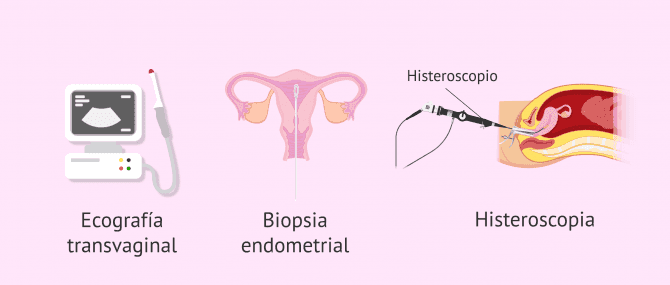 Imagen: Pruebas diagnósticas para la hiperplasia endometrial