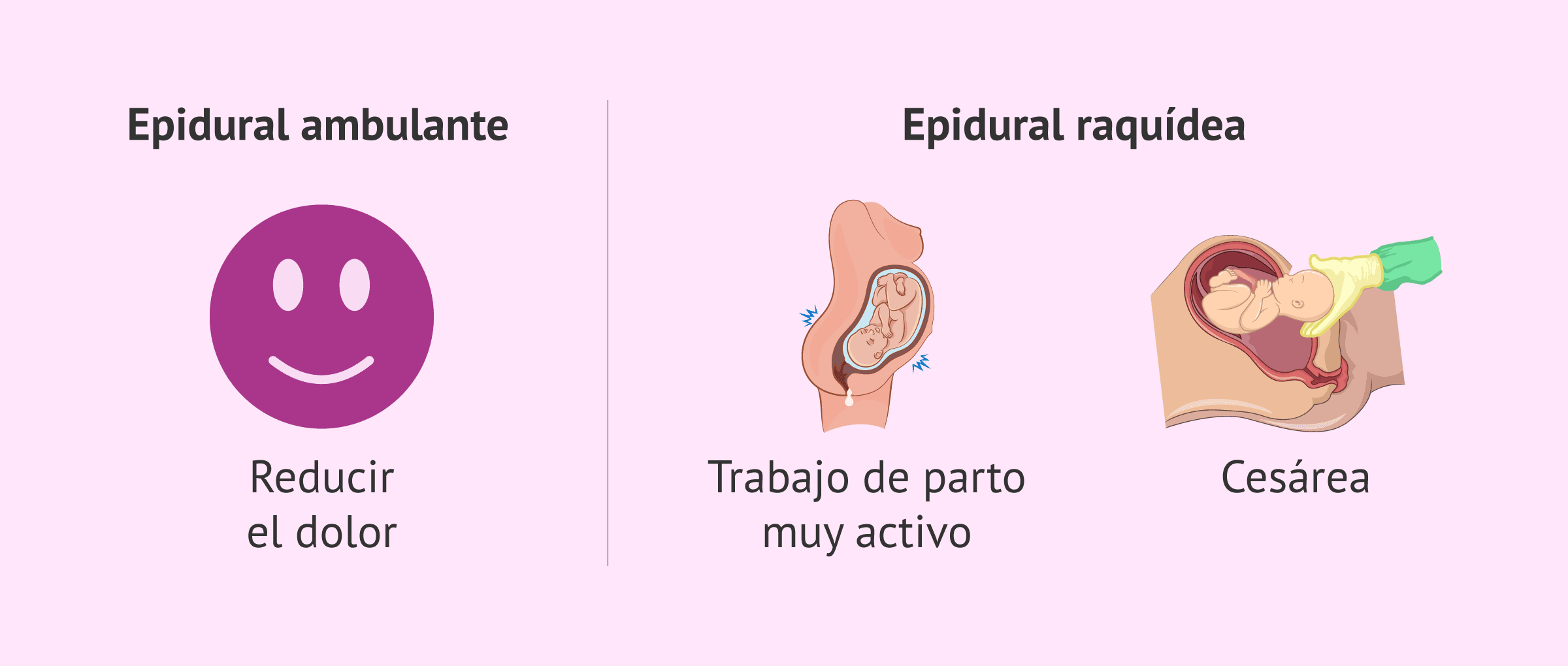 Imagen: ¿Cuándo se usa cada tipo de epidural?