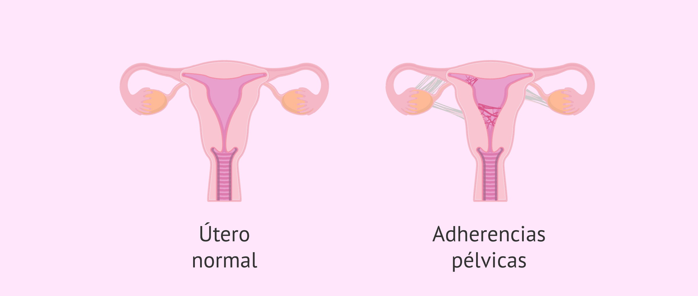 ¿Qué son las adherencias pélvicas?