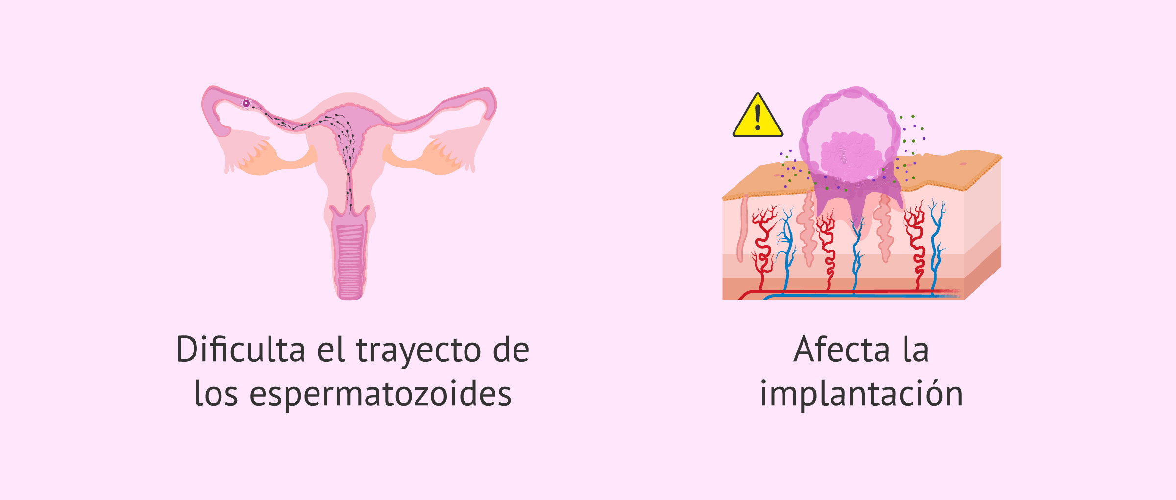 Imagen: ¿Por qué puede afectar la adenomiosis a la fertilidad?