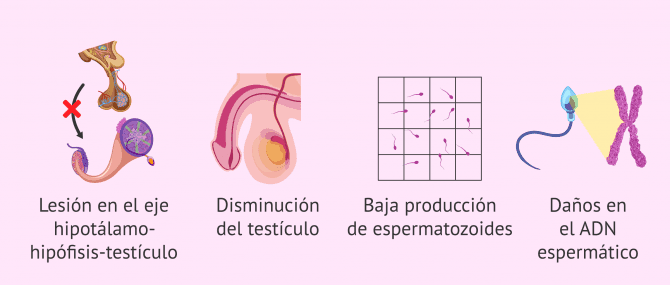 Imagen: Consecuencias del varicocele en la fertilidad