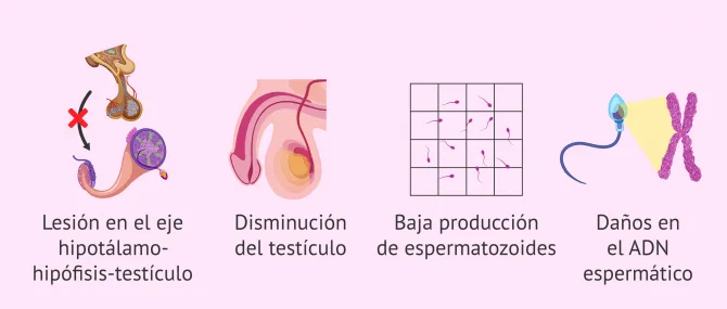Imagen: Consecuencias del varicocele en la fertilidad