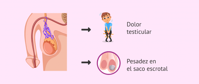 Imagen: Síntomas del varicocele secundario