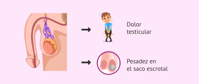 Imagen: Síntomas del varicocele secundario