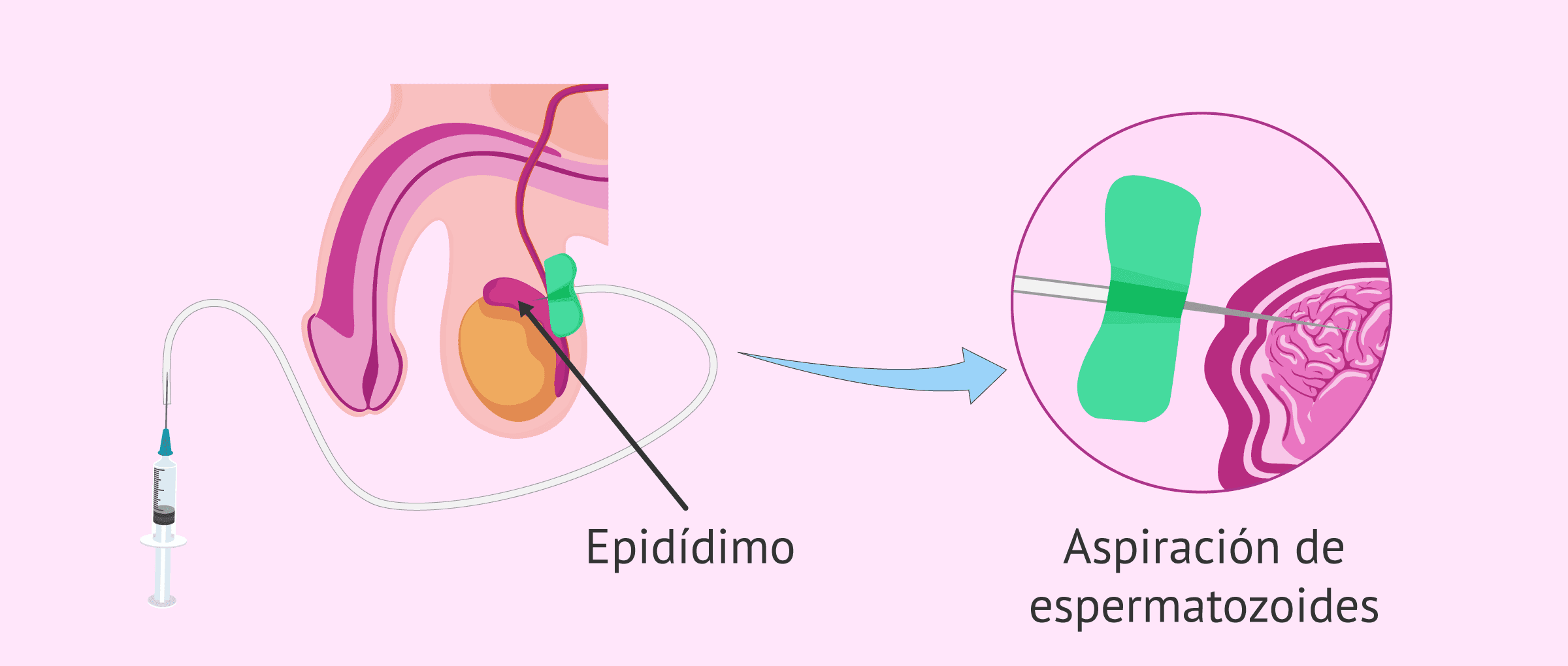 ¿Qué es la aspiración de espermatozoides del epidídimo?