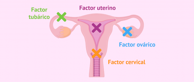 Imagen: Origen de la esterilidad femenina