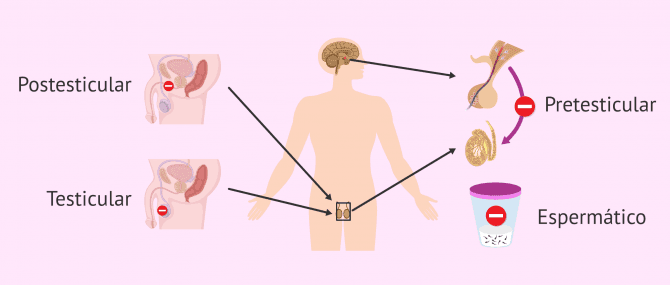 Imagen: Origen de la esterilidad masculina