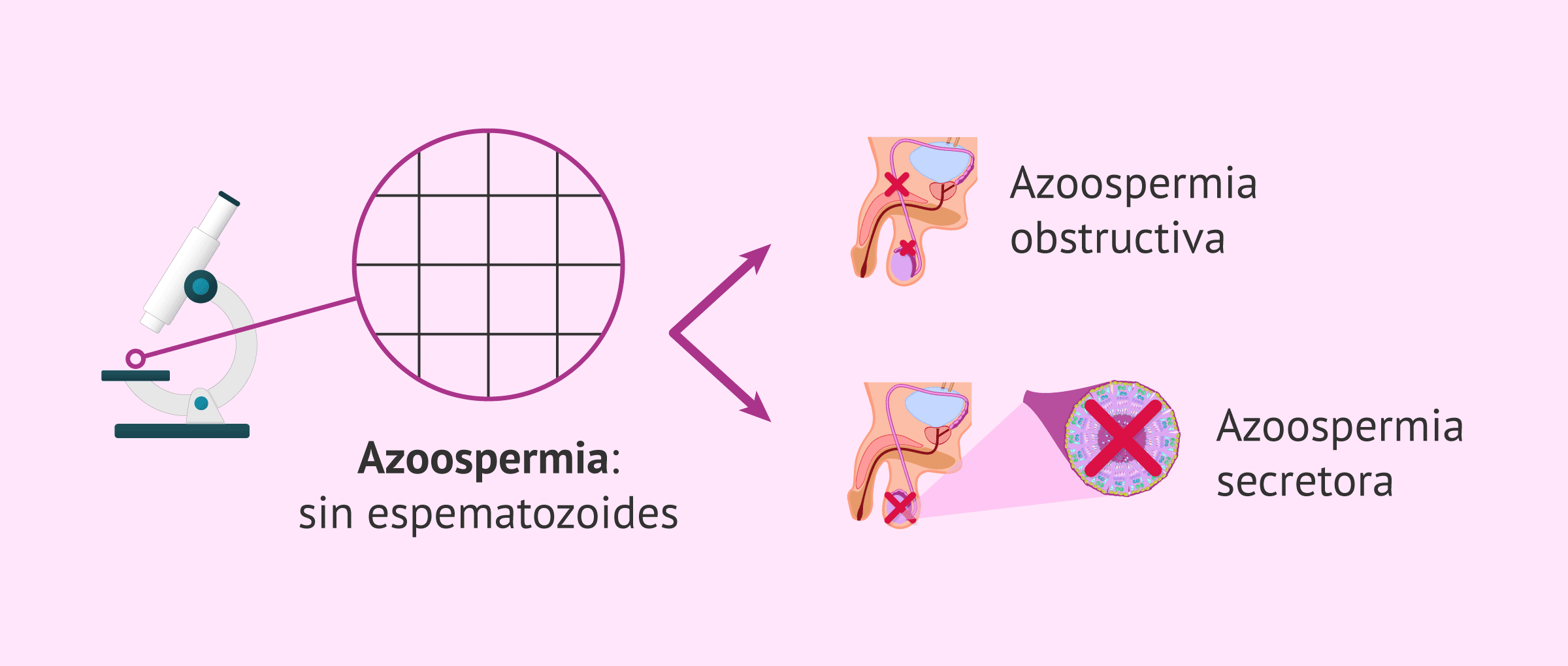 Imagen: ¿Cómo puede ser la azoospermia?