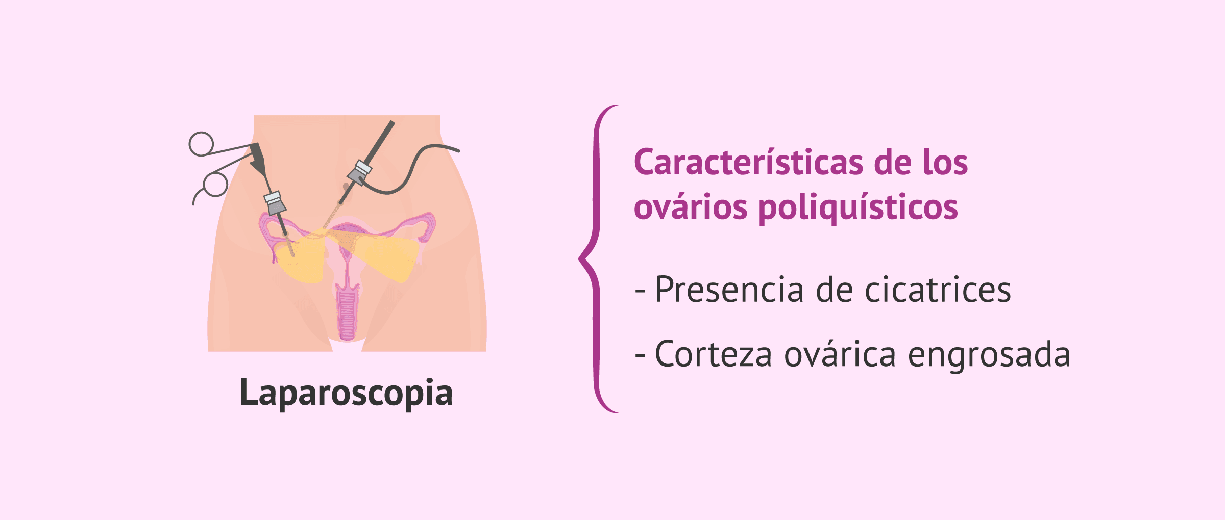 Imagen: Laparoscopia para el diagnóstico del SOP