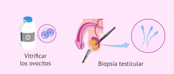 Imagen: Opciones para obtener espermatozoides