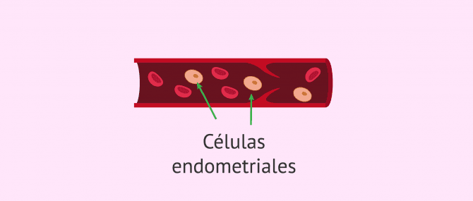 Imagen: Teoría de la diseminación vascular o linfática