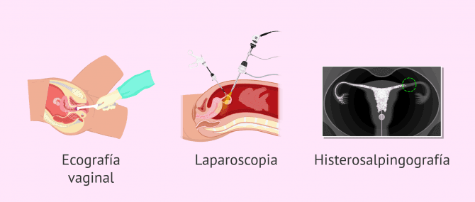 Imagen: Pruebas diagnósticas para el hidrosalpinx