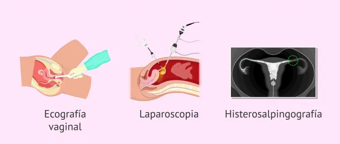 Imagen: Pruebas diagnósticas para el hidrosalpinx