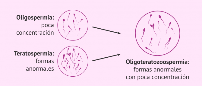 Imagen: Oligoteratozoospermia