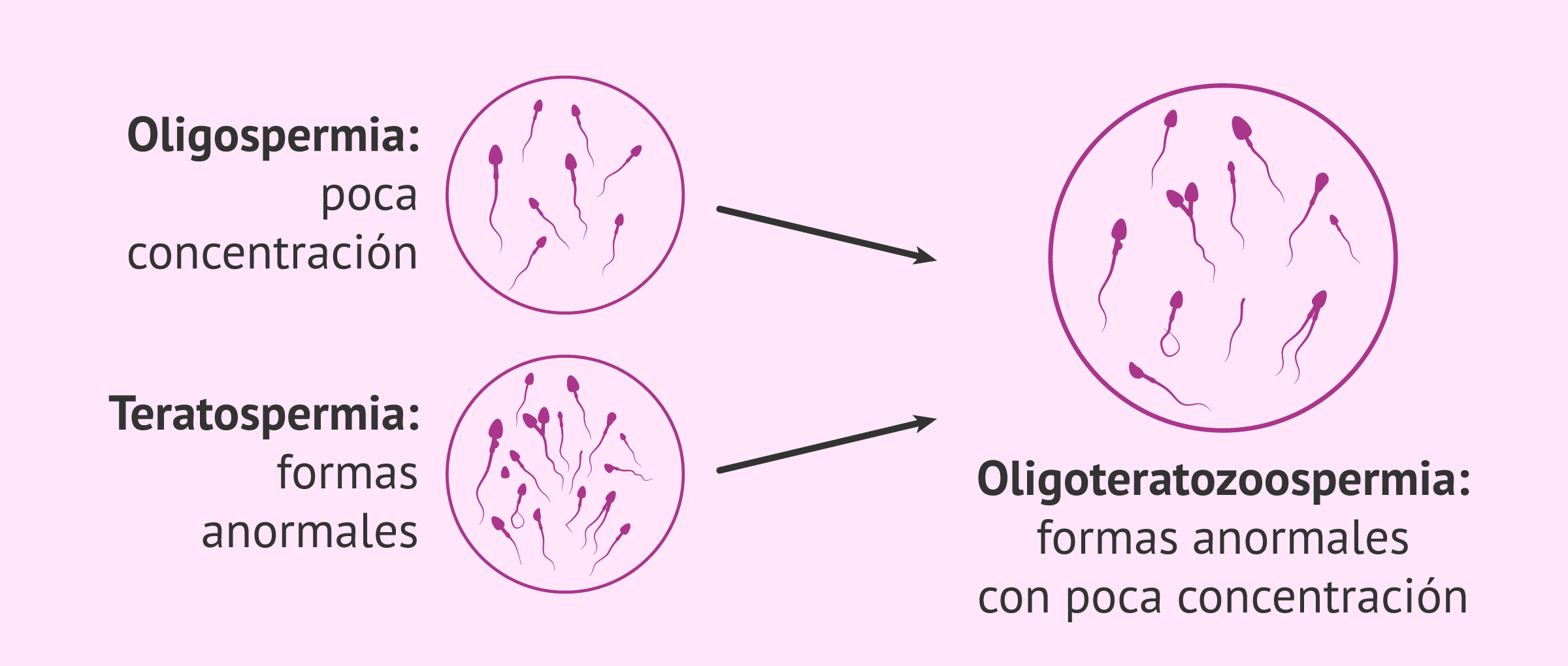 ¿Qué es la oligoteratozoospermia?