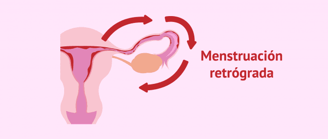 Imagen: Menstruación retrógrada