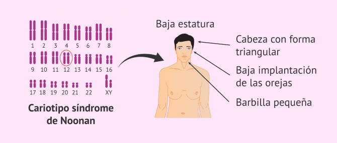 Imagen: sindrome-de-noonan-glosario