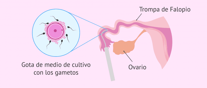 Imagen: tranferencia-gift-gametos-a-trompas
