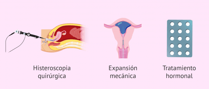 Imagen: Tratamiento del síndrome de Asherman