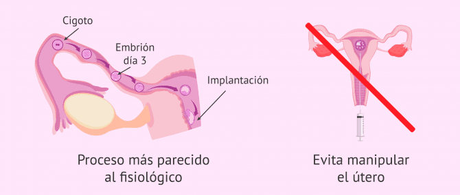 Imagen: Ventajas de la transferencia intratubárica de cigotos