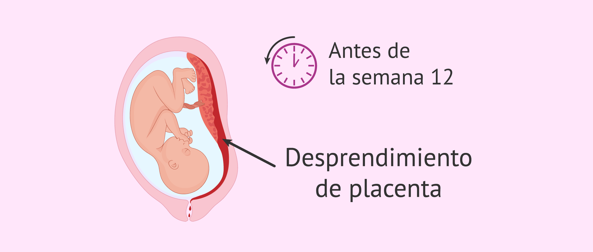 ¿Qué es el abruptio placentae?