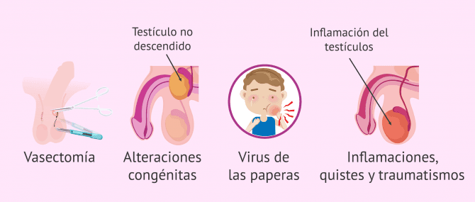 Imagen: Posibles causas de la azoospermia obstructiva