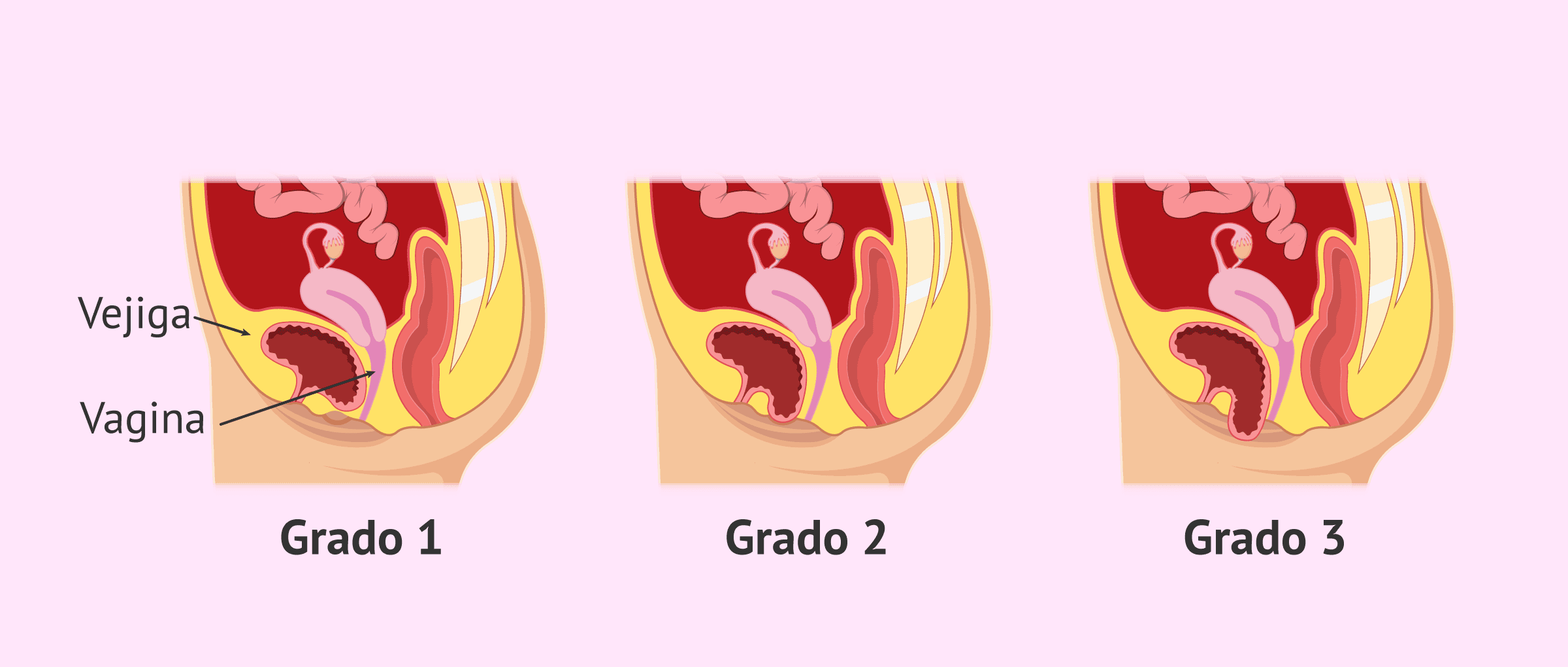 ¿Qué es el cistocele?
