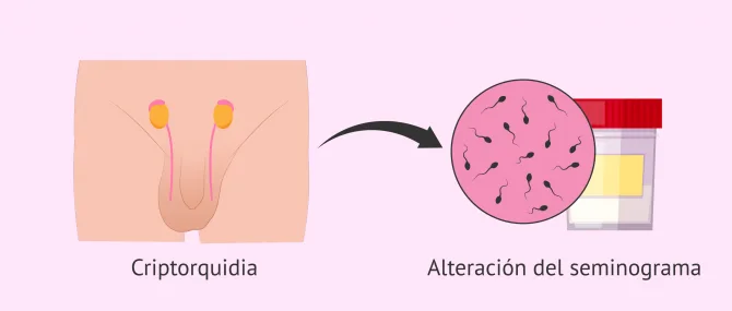 Imagen: ¿Influye la criptorquidia en la fertilidad masculina?