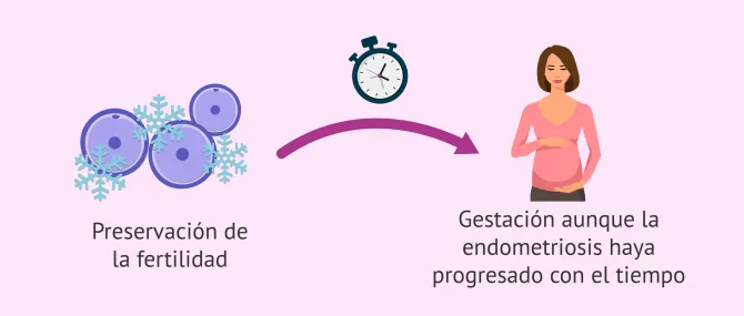 Imagen: Endometriosis y preservación de la fertilidad