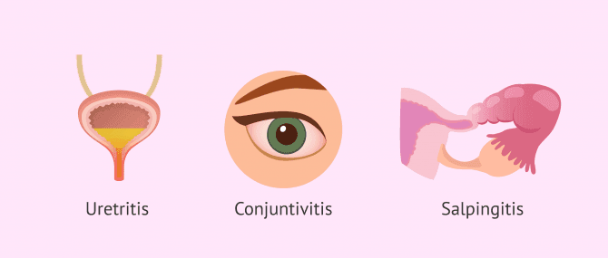 Imagen: sintomas-clamidia-uretritis-conjuntivitis-salpingitis