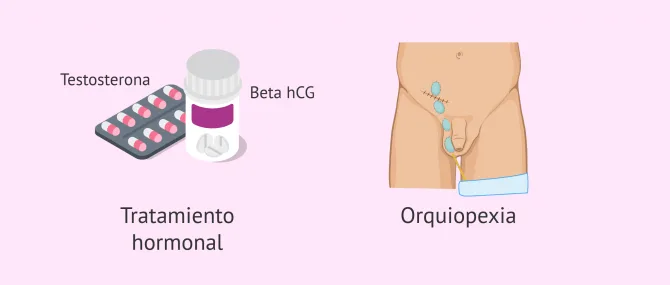 Imagen: Posibles tratamientos para la criptorquidia