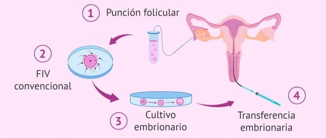 Imagen: Fecundación in vitro convencional
