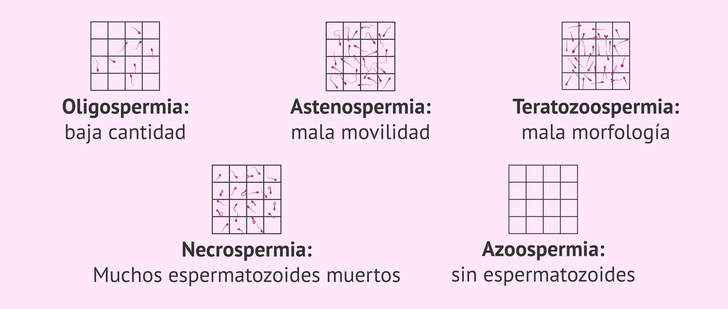 Imagen: Causa espermática de infertilidad en el varón