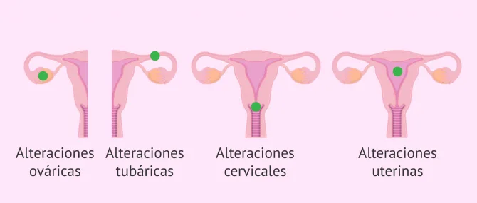 Imagen: ¿Por qué se produce la infertilidad femenina?