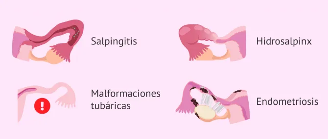 Imagen: Causas del factor tubárico en la mujer