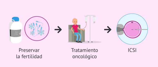 Imagen: Preservación fertilidad en pacientes oncológicos