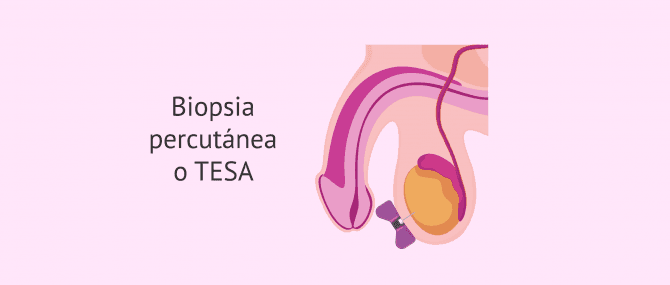 Imagen: biopsia-percutanea-o-tesa