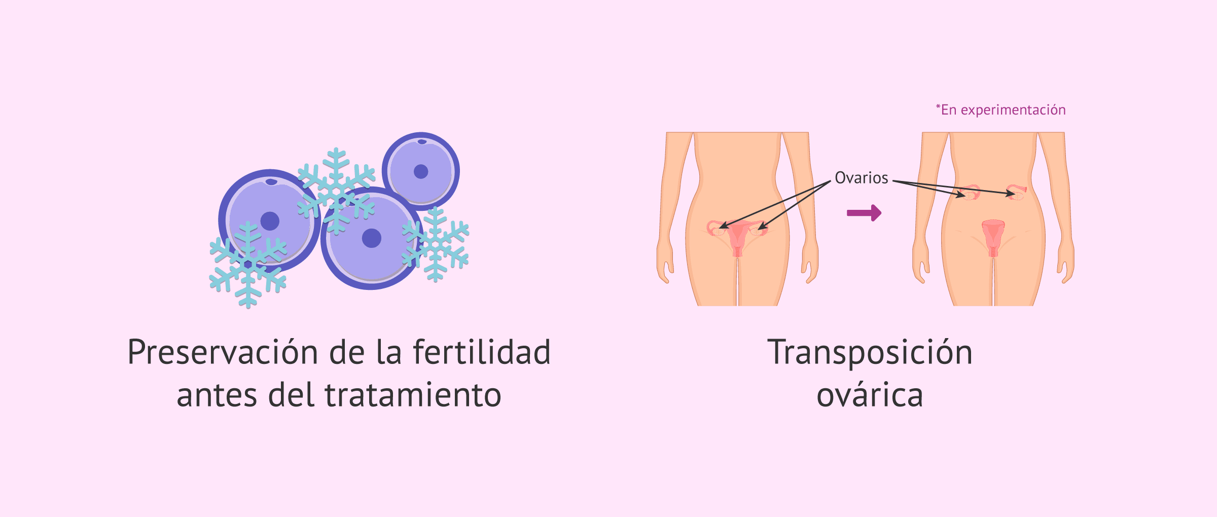 Imagen: Opciones de embarazo con cáncer cervical