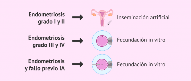 Imagen: Endometriosis y tratamiento de fertilidad