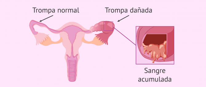 Imagen: hematosalpinx