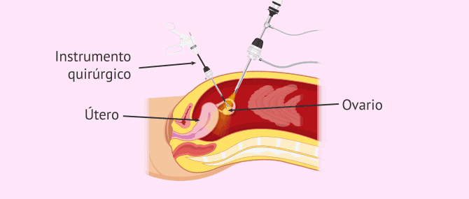 Imagen: ooforectomia-extirpacion-ovario
