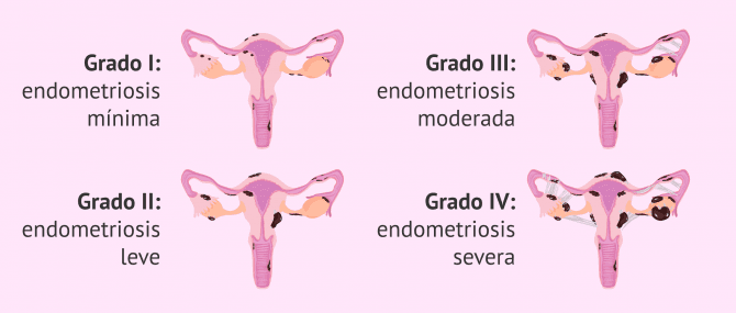 Imagen: ¿Cuáles son los grados de endometriosis?