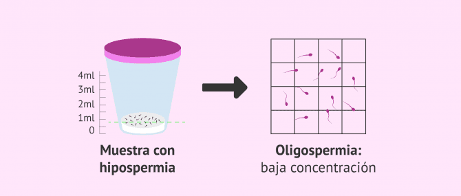 Imagen: La hipospermia se asocia con la oligozoospermia