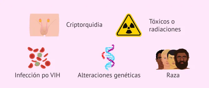 Imagen: Factores de riesgo para el cáncer testicular