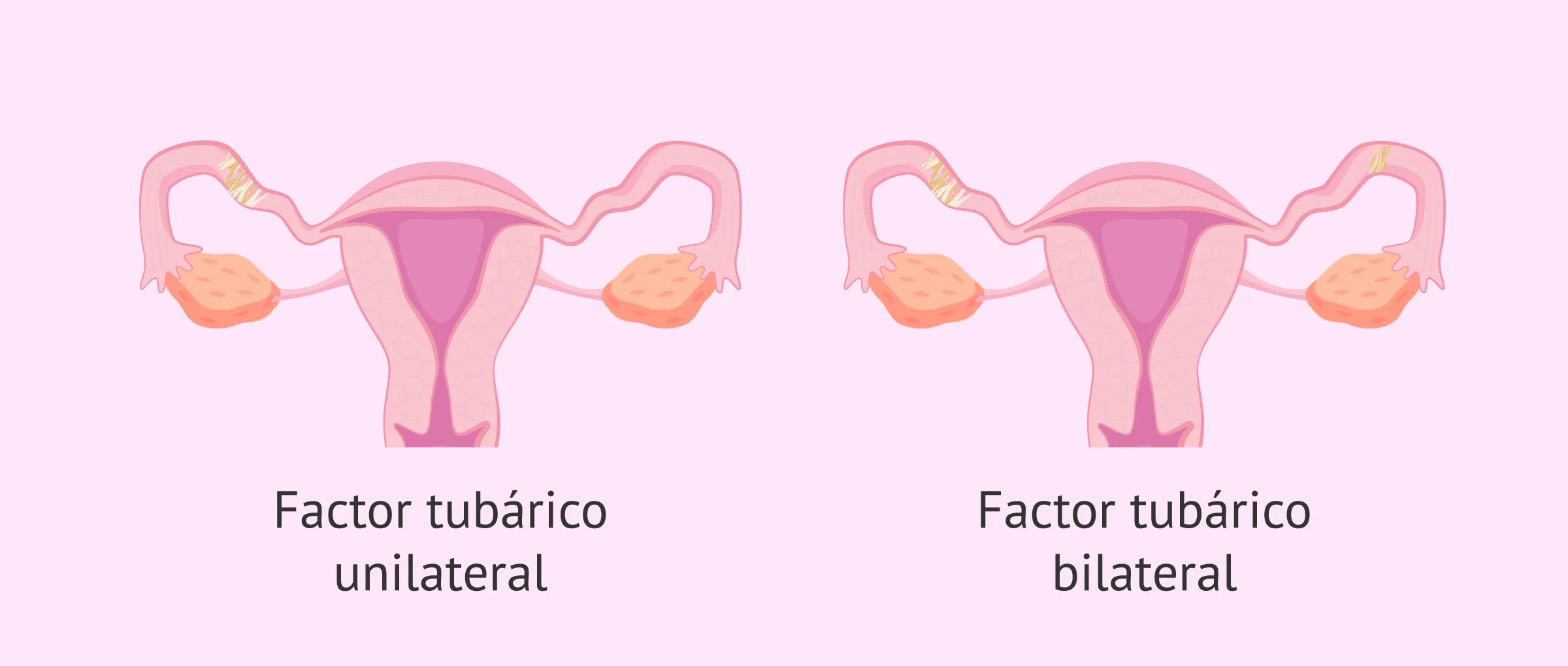 Factor tubárico