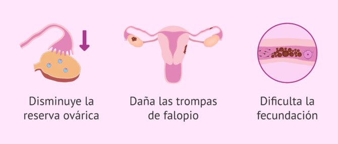 Imagen: ¿Qué efectos tiene la endometriosis en la fertilidad?