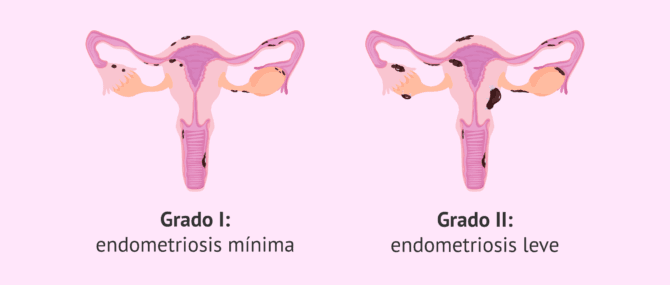 Imagen: Endometriosis de grado I y II